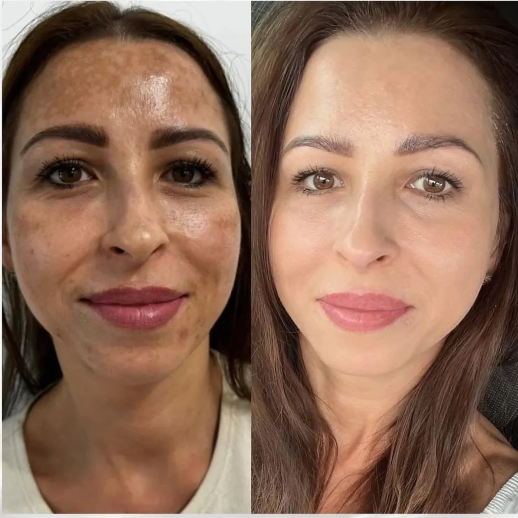 MelantraX Advanced Anti-Hyperpigmentation Essence